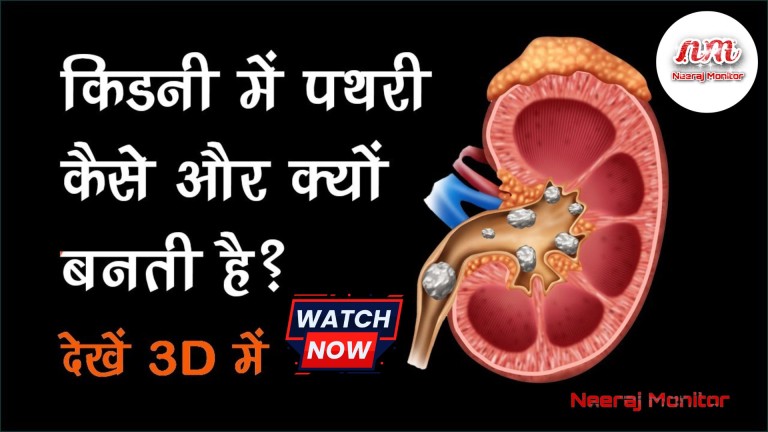 What is the main cause of kidney stone formation